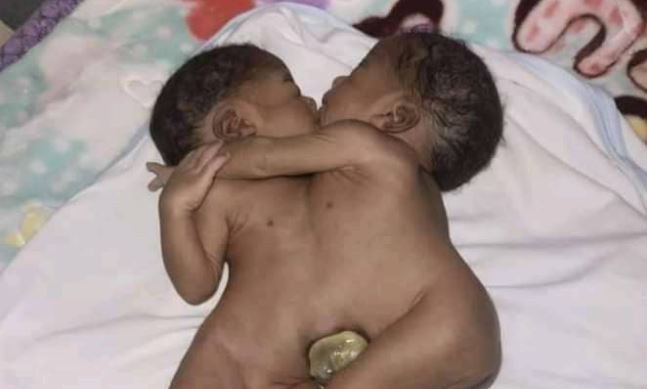 Les jumelles siamoises n’ont pas survécu à l’hôpital militaire de Brazzaville